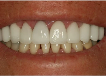 Close-up of a smile showing upper teeth with white dental crowns and natural lower teeth.