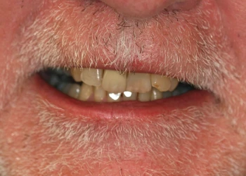 Close-up of an older person's mouth showing weathered teeth and white facial hair around the lips.