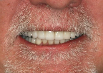 Close-up of an elderly man's smile showing his teeth and white facial hair around his mouth.