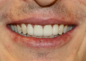 Close-up of a person's mouth smiling, showing slightly yellowed upper teeth and some facial hair above the lip.