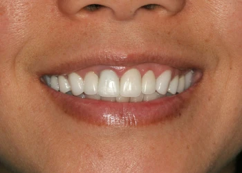 Close-up of a person's smile showing clean white teeth and pink gums.