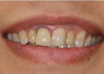 Close-up of a person's mouth showing uneven, discolored teeth with some staining.