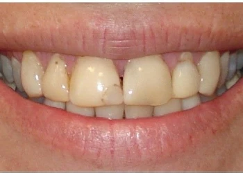 Close-up of a person's smile with discolored and uneven front teeth.