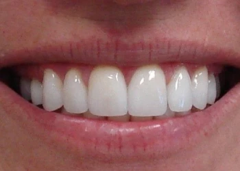 Close-up of a person's mouth smiling, showing clean, straight white teeth.