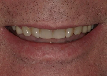 Close-up of a smiling person's mouth showing upper teeth.