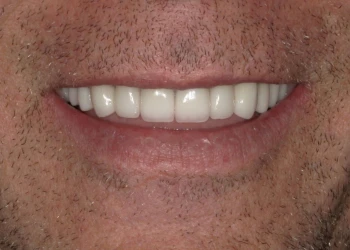 Close-up of a person smiling showing white teeth and stubbled facial hair around the mouth.