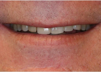 Close-up of a person's mouth smiling with visible upper teeth and lips.
