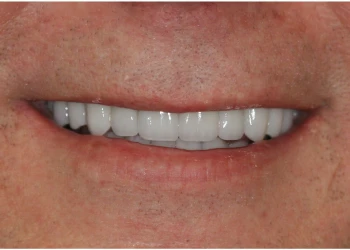 Close-up of a person's closed-mouth smile showing white, even teeth.