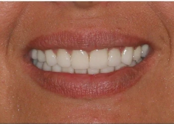 Close-up of a smiling mouth with white teeth and natural-colored lips.