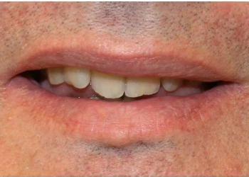 Close-up of a man's mouth showing slightly parted lips and natural teeth with some facial hair on the skin around the mouth.