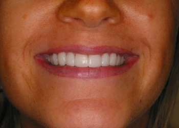 Close-up of a smiling mouth with straight, white teeth and visible lips.