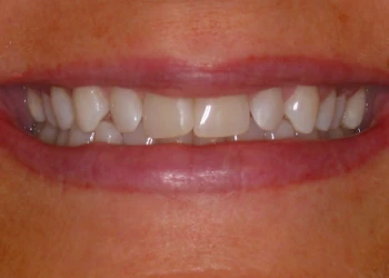 Close-up of a smiling mouth showing slightly uneven but clean upper teeth and pink lips.
