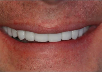 Close-up of a smiling mouth showing white, straight teeth and a mustache above the upper lip.