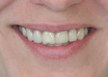 Close-up of a person's smile showing unevenly colored upper front teeth.
