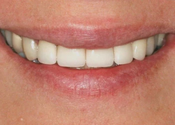Close-up of a person smiling showing clean, white teeth and closed lips.