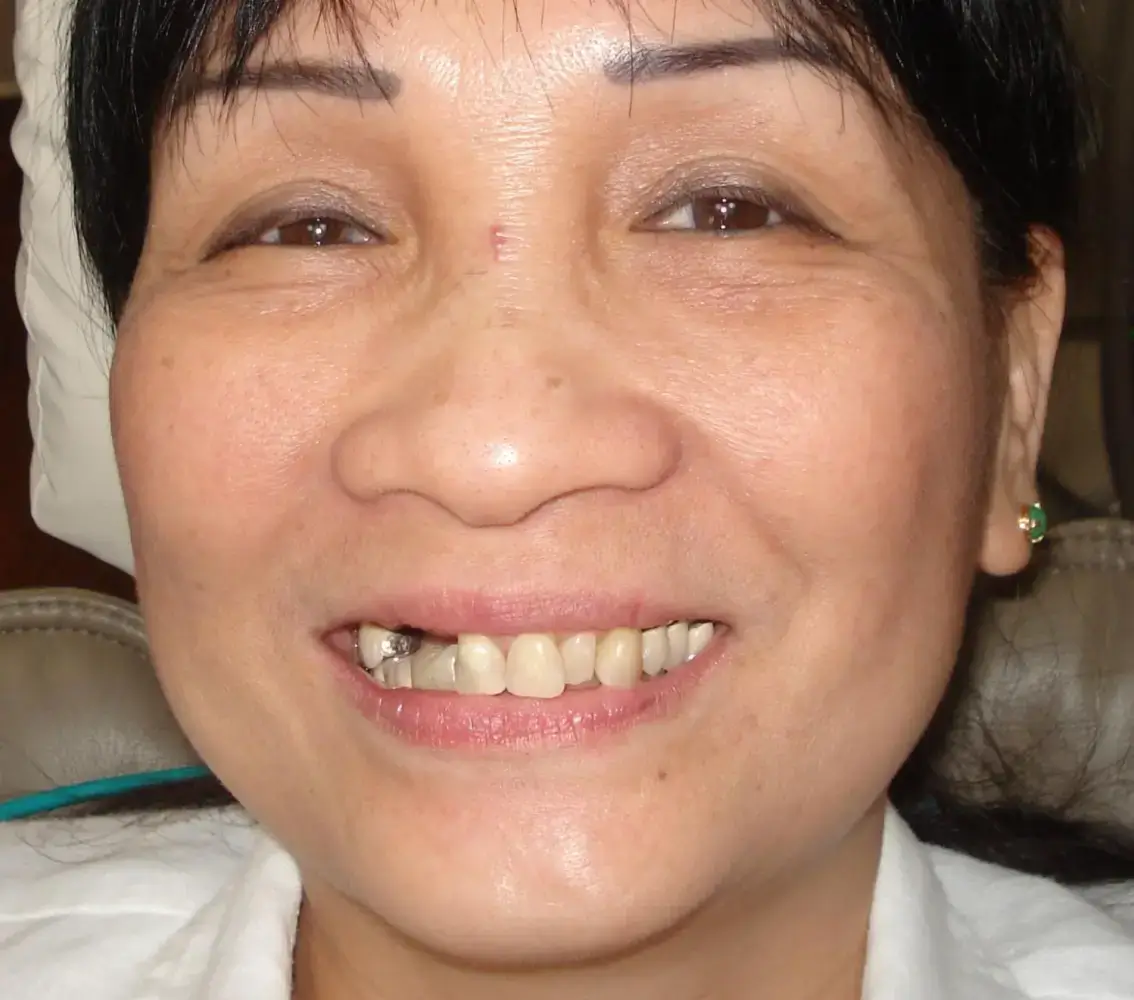 Close-up of a woman smiling, showing teeth with a dental crown on a molar.