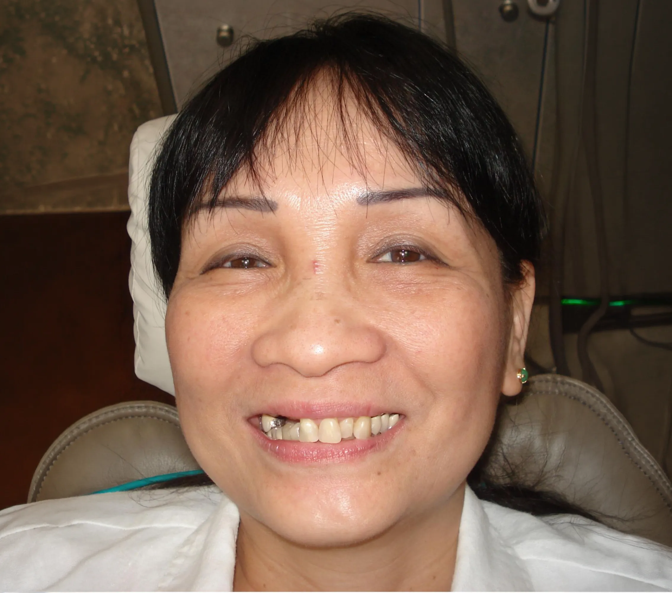 The Smile Lift - YuvaLift™ before