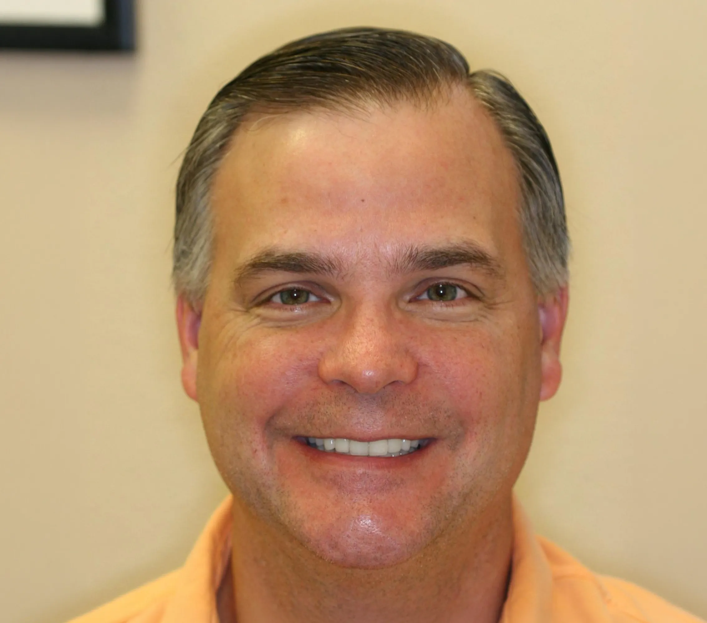 The Smile Lift - YuvaLift™ after