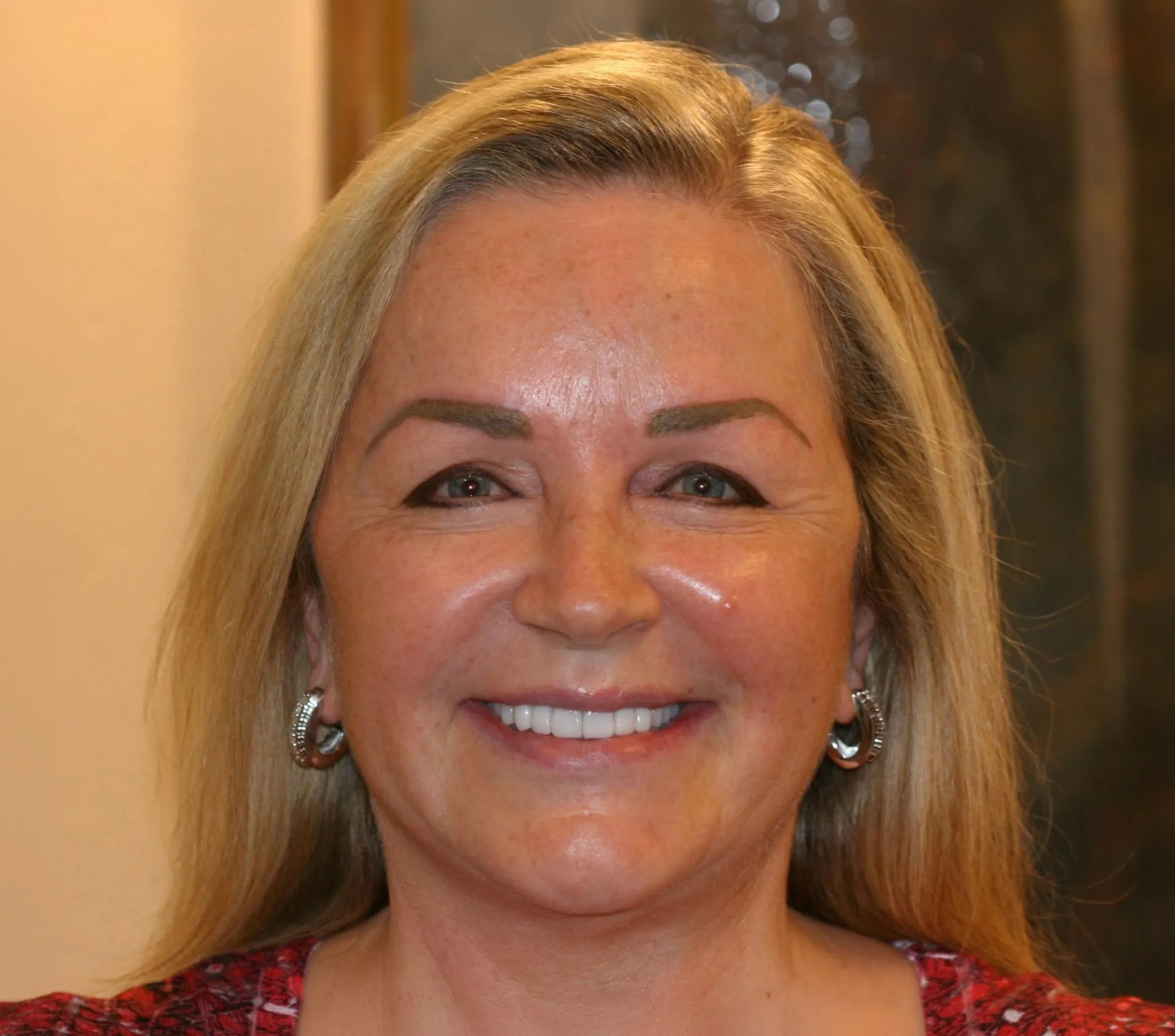 The Smile Lift - YuvaLift™ after