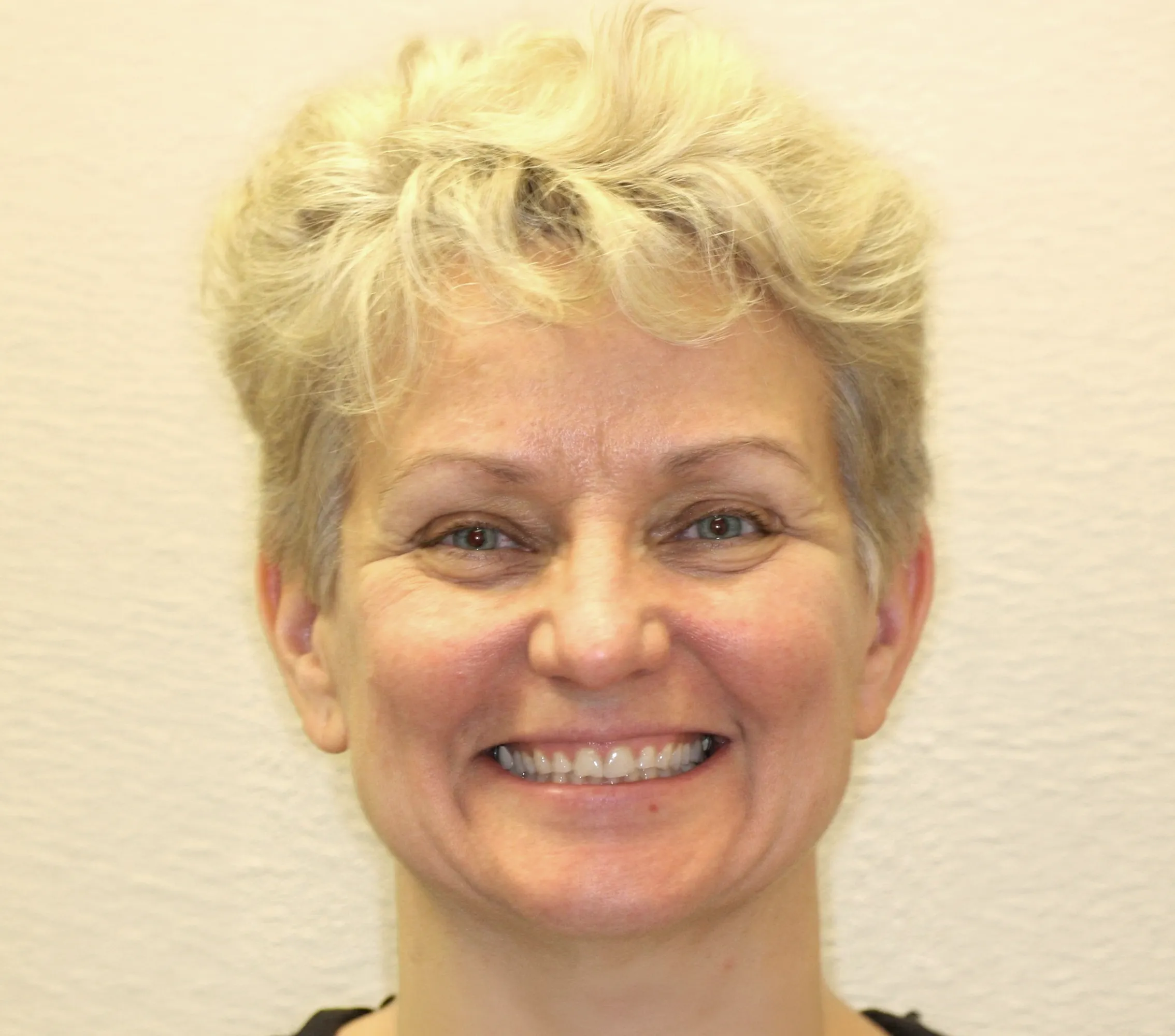 The Smile Lift - YuvaLift™ before