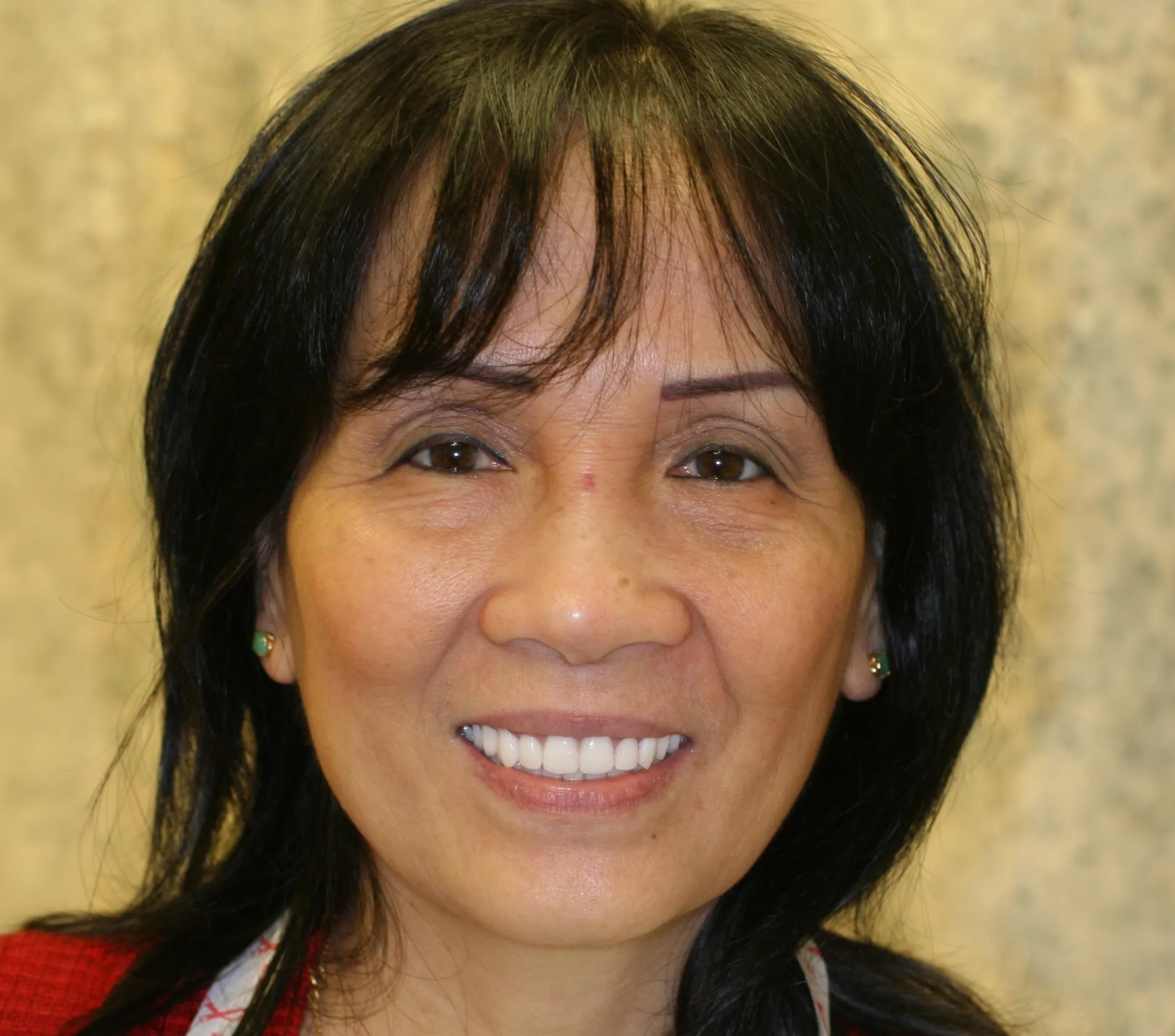 The Smile Lift - YuvaLift™ after