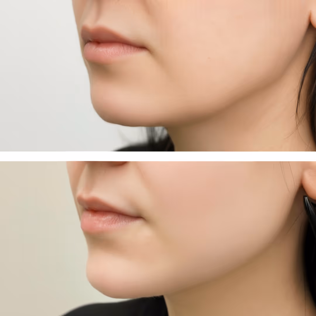 Ennen ja jälkeen leuan kärjen muotoilua