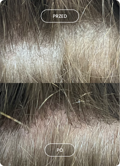 Zdjęcie przed i po pokazujące różnicę w gęstości włosów na skórze głowy, z większą gęstością na dole.