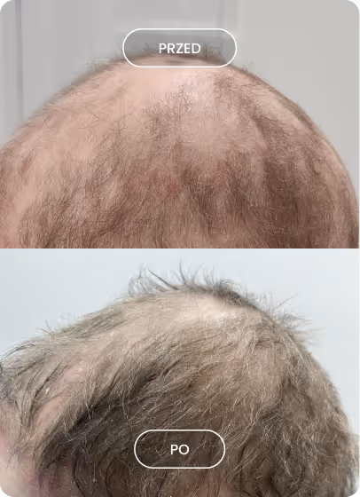 Porównanie zdjęć głowy z góry: u góry z przerzedzonymi włosami i widoczną skórą oznaczone jako 'przed', u dołu z zagęszczonymi włosami oznaczone jako 'po'.
