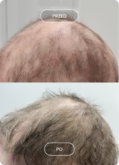 Porównanie zdjęć głowy z góry: u góry z przerzedzonymi włosami i widoczną skórą oznaczone jako 'przed', u dołu z zagęszczonymi włosami oznaczone jako 'po'.