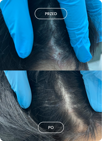 Porównanie skóry głowy przed i po zabiegu, gdzie widoczne zmniejszenie zaczerwienienia i łupieżu oraz poprawa stanu skóry.