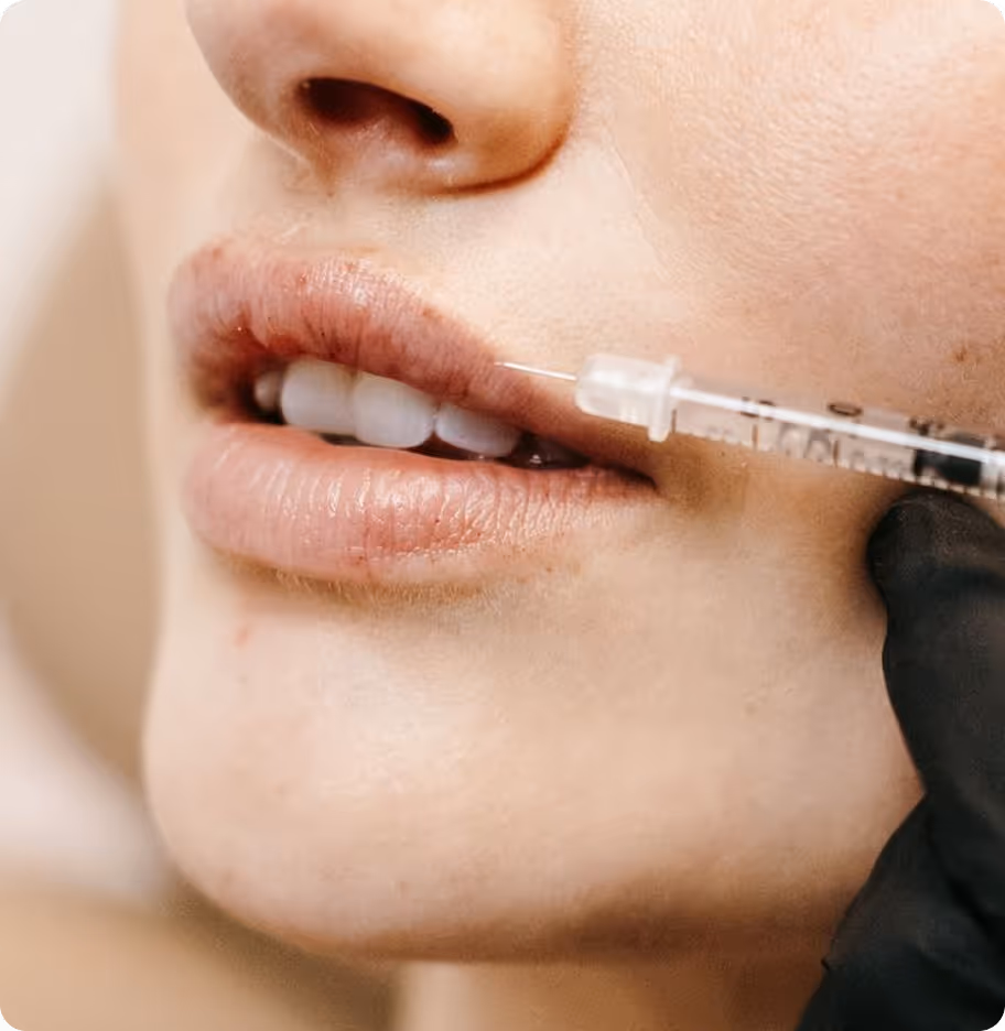 Gros plan sur une injection esthétique dans les lèvres d’une femme
