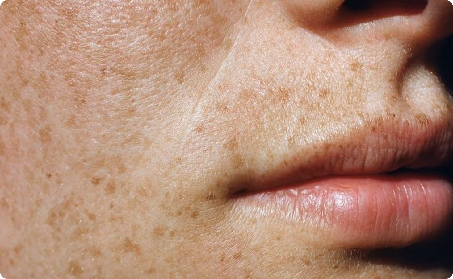 Gros plan sur les lèvres et les taches de rousseur d’une femme à la peau claire
