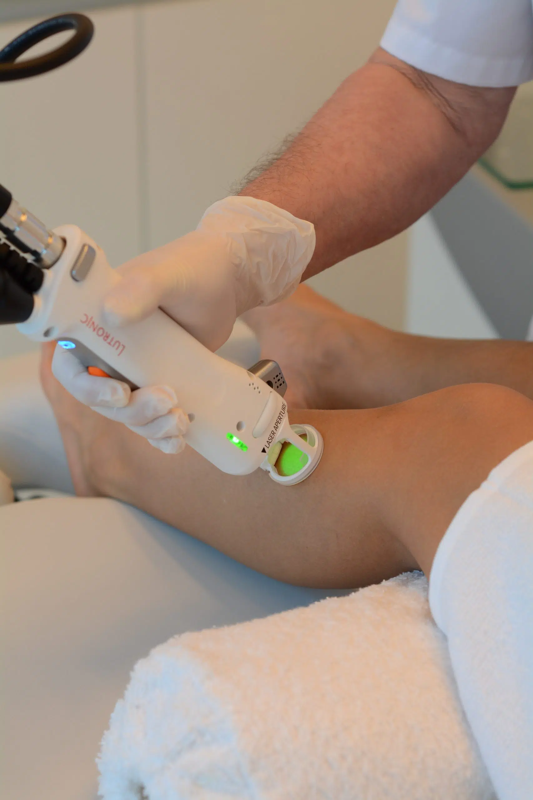 Laser utilisé sur une jambe pour traiter les poils ou varicosités