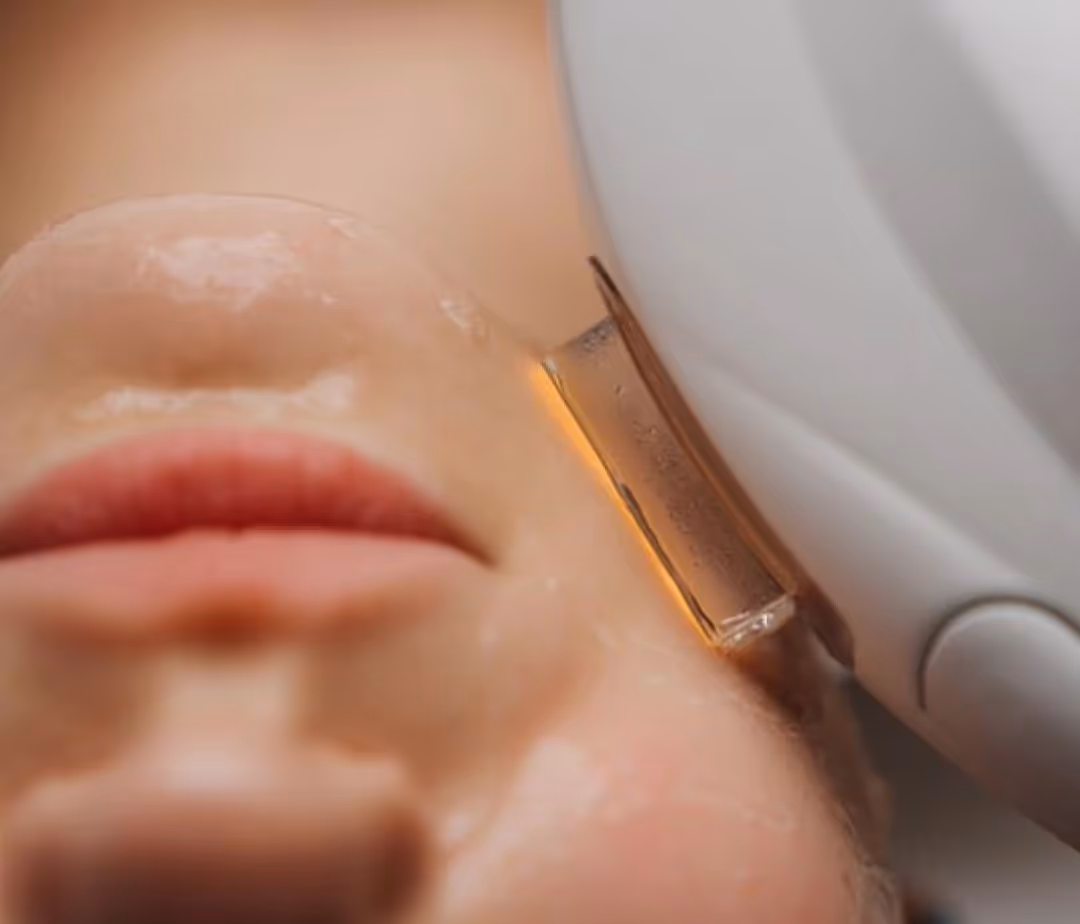 Application de lumière pulsée intense (IPL) sur le visage pour soin cutané