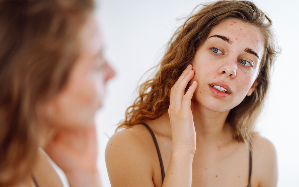 Why Am I Breaking Out?