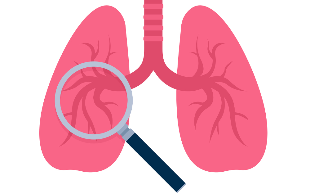 Clearing the Air: Your Lung Cancer Screening Questions Answered