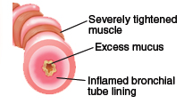 Severely inflamed airway and bronchial tube lining