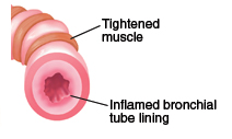 Inflamed airway and bronchial tube lining