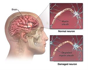 Brain inside skull with details of normal and damaged neurons