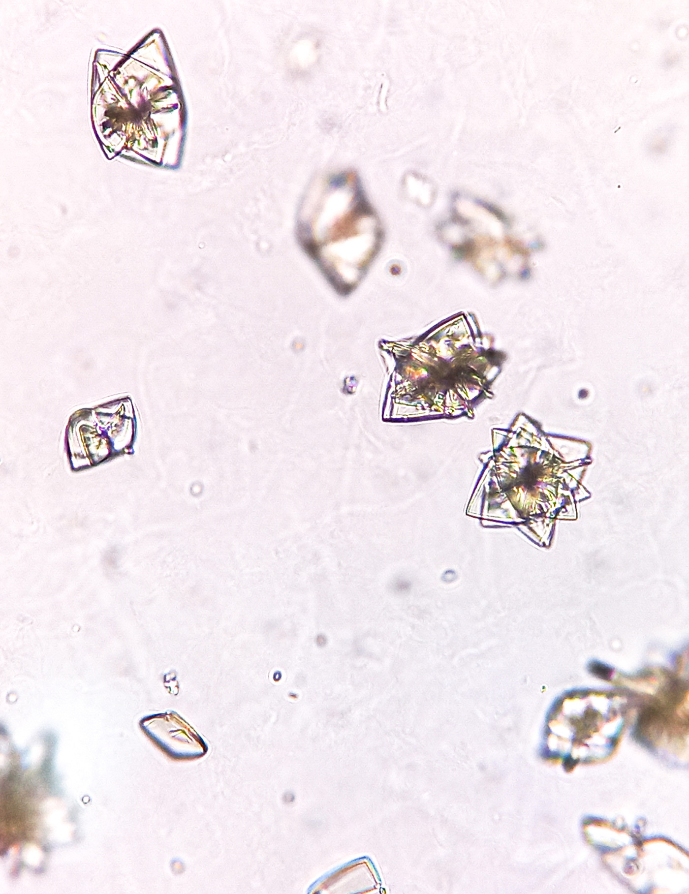 Kidney Stones: Symptoms, Severe Pain and When to Seek Care