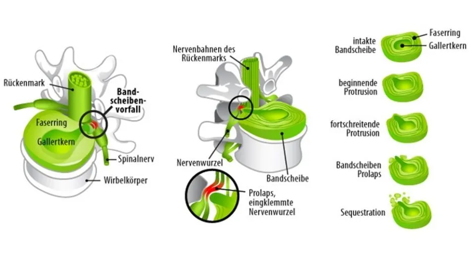 Bandscheibe Verletzung