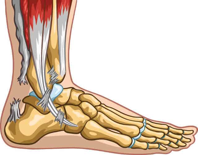 achilles-tendon-rupture-1