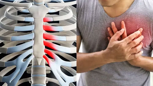 costochondritis, rib pain relief in toronto