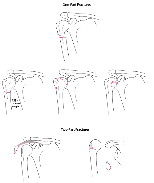This image has an empty alt attribute; its file name is types-of-humerus-fractures.gif