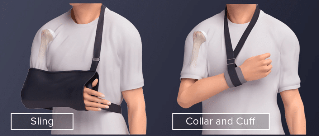 This image has an empty alt attribute; its file name is sling-types-broken-arm-1024x437.png