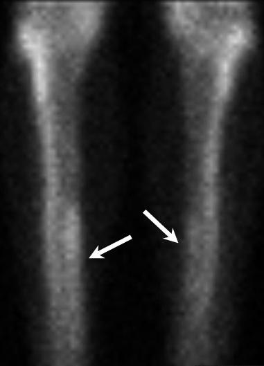 bone-scan-shin-splints