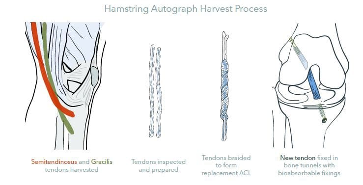 acl-surgery-procedure