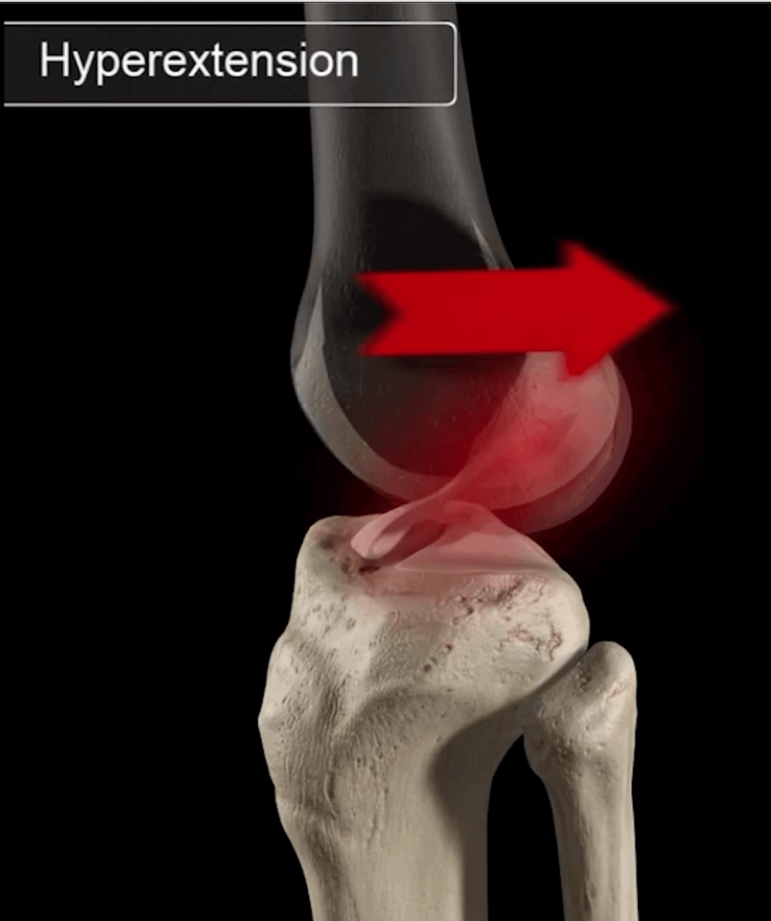 acl-tear-mechanism-hyperextension