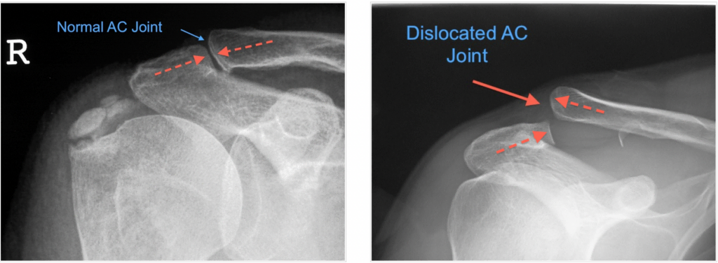 x-ray-of-normal-versus-seaparated-ac-joint-1024x376