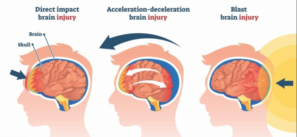 types-of-concussion-injury-mechanisms-1024x474